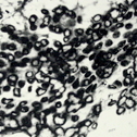 Cancer Cells Part 1 thumb